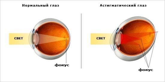 Сколько стоит операция на коррекцию зрения в уфе