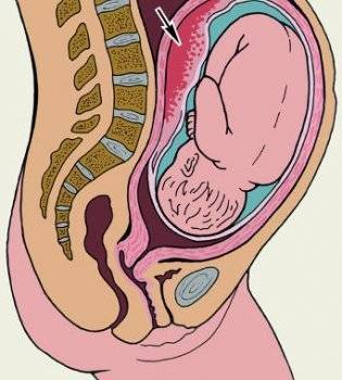 Как выходит и рассасывается гематома матки при беременности
