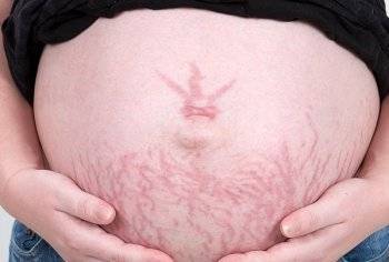 Что делать что бы не появились растяжки на груди и животе при беременности, как их потом убрать