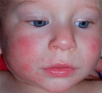 аллергия на лице у ребенка фото