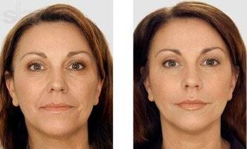 контурная пластика лица до и после фото