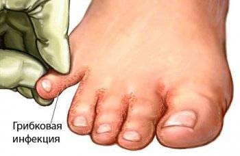 как лечить грибок на ногтях ног фото