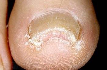 грибковое поражение ногтей фото