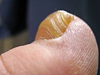 грибок ногтей фото