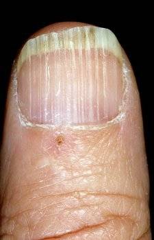 заболевания ногтей фото