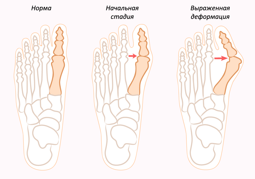 Почему перестала расти нога. Деформация hallux valgus вальгусная. Вальгусная деформация 1 пальца стопы. Хальгус вальгус стоп степени. Вальгусная деформация стопыбрлшого пальца.