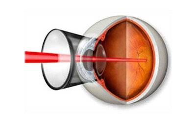 Дистрофия сетчатки глаза – лечение