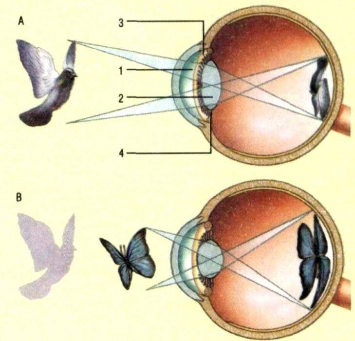 Если глаз человека строит изображение далеких предметов перед сетчаткой глаза страдает