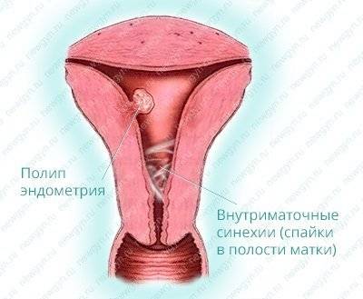 Гиперплазия матки