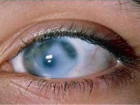 Чем опасна вторичная глаукома